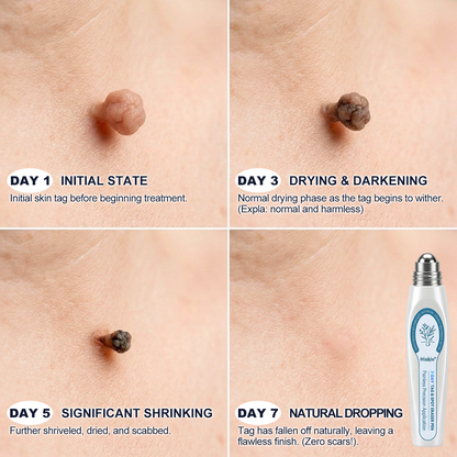 𝑯i𝒔𝒌𝒊n® 7-𝐷𝑎𝑦 𝗧𝐚𝐠 & 𝗦𝗽𝐨𝐭 𝐄𝐫𝒂𝒔𝒆𝒓✅🎉(Zero Pain, Zero 𝐒𝐜𝐚𝒓𝒔 Rollerball)